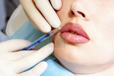 Cosmetic injection in the female lips
