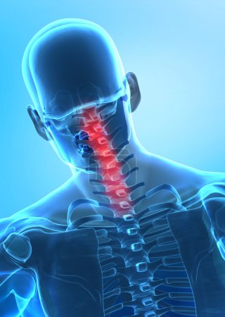 Pain in cervical spine concept