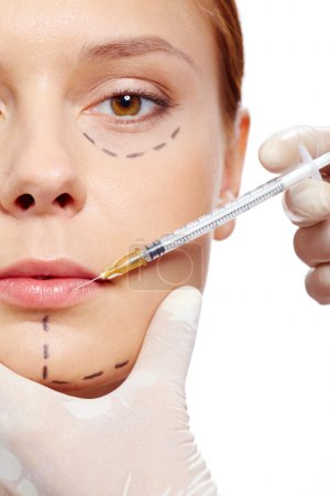 Injection of collagen